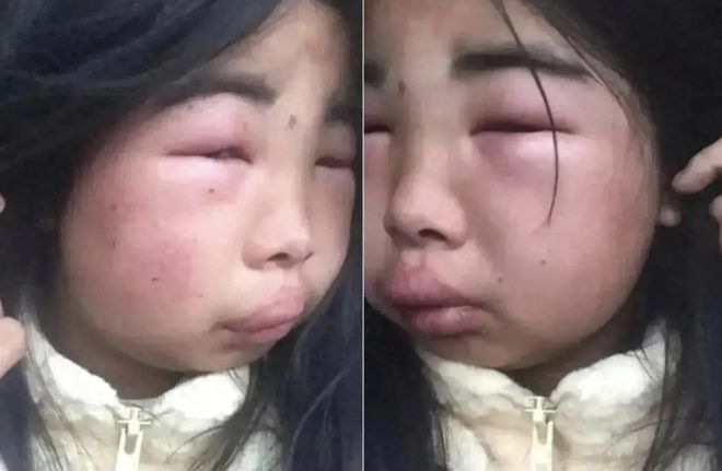 網(wǎng)曝12歲女孩感染HPV事件揭秘，真相與挑戰(zhàn)的應(yīng)對之道