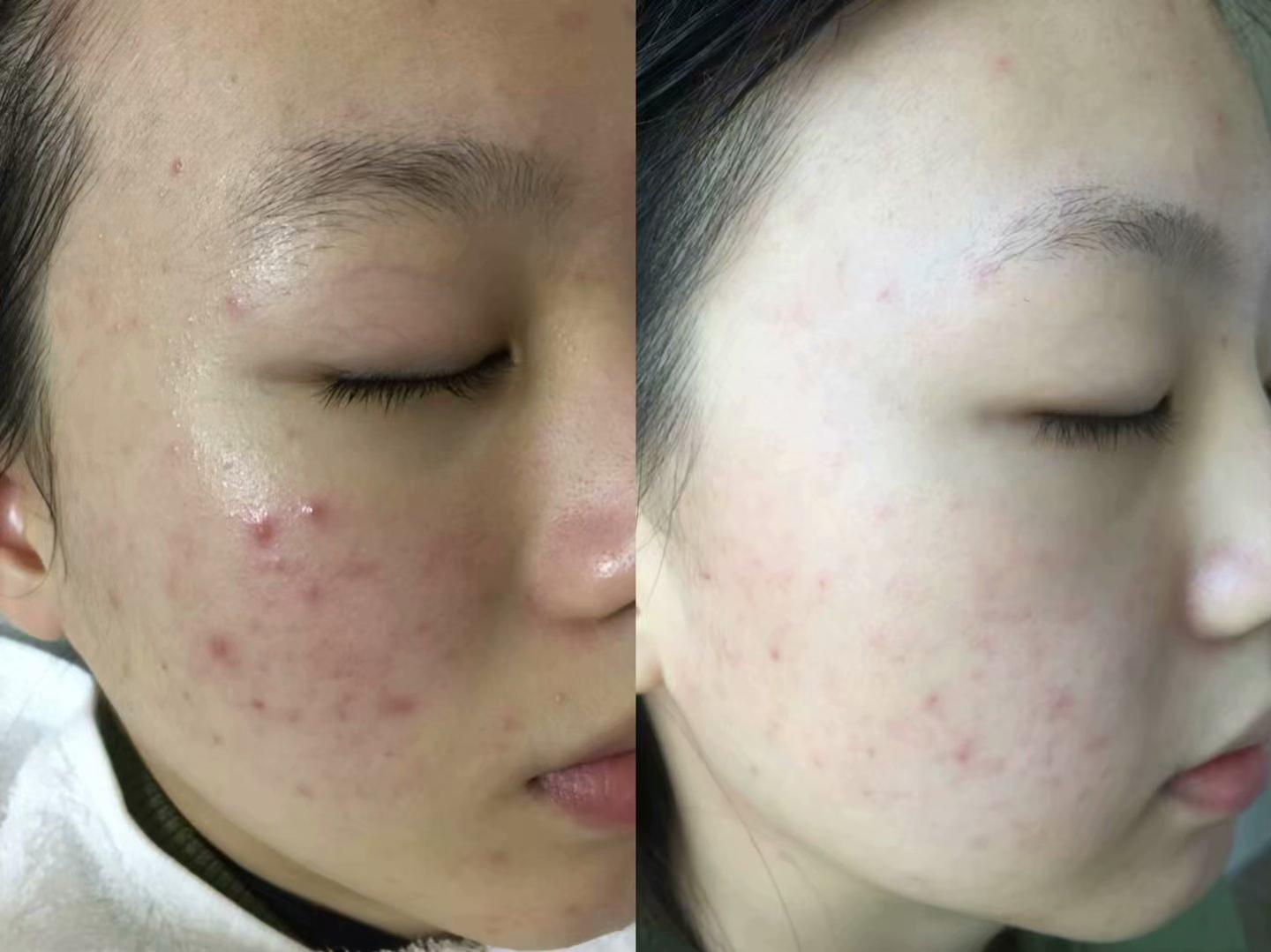 痘痘貼年收入達(dá)6億，市場現(xiàn)象背后的成功解析與洞察